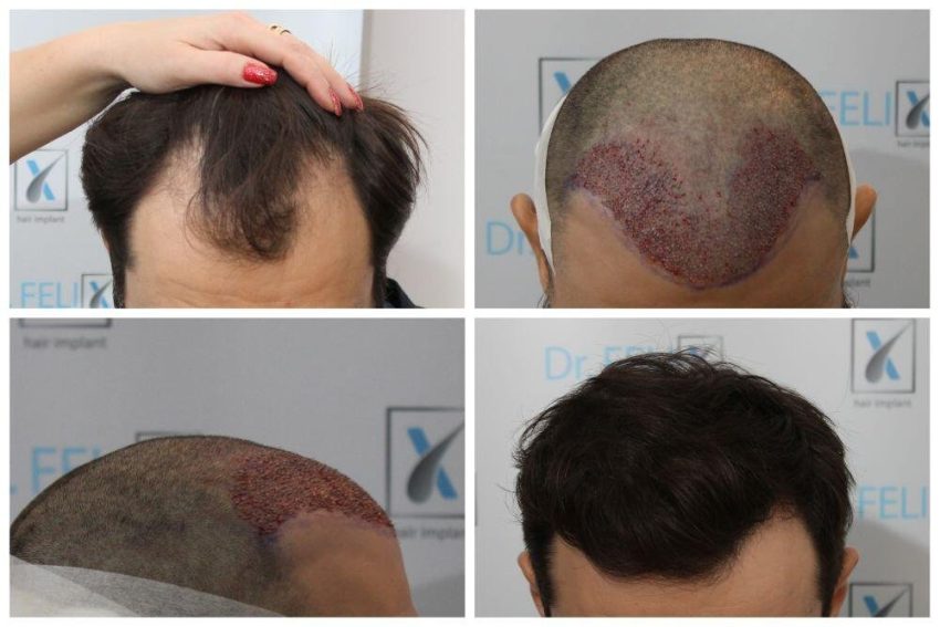 implant de păr